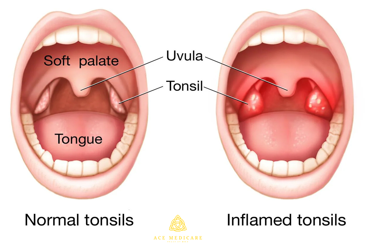 Natural Remedies for Soothing Tonsillitis Symptoms at Home